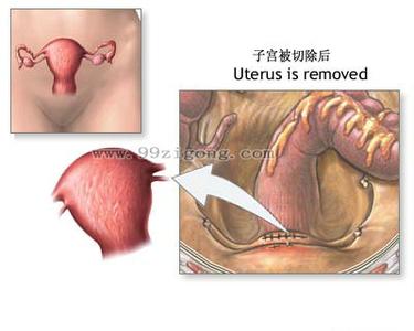 女人切除子宫后的图片 切除子宫后女人会怎样