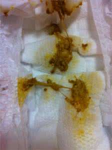 顺产后大便黑色正常吗 剖腹产后大便黑色正常吗
