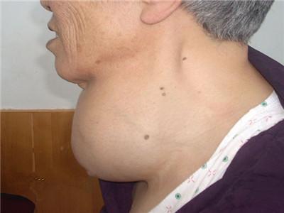 甲亢的治疗方法 甲亢能治愈吗 甲亢的治疗方法及日常防护