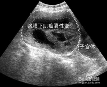 子宫肌瘤特效验方 图文:现代女性多发的子宫肌瘤特效验方