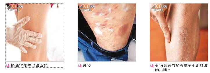 2017年阴滋病最新消息 2017年阴滋病最新消息 阴滋病怎么检查？