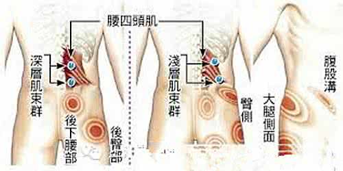 腰背肌筋膜炎能治好吗 腰背肌筋膜炎能治好吗？