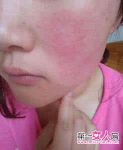 红血丝注意事项 红血丝注意事项 白带有血丝需注意的事项