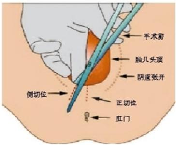 顺产怎么样可以不侧切 顺产侧切是什么