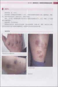 中华内分泌代谢杂志 皮肤病各论之十七：内分泌、代谢、营养障碍性疾病〔07〕