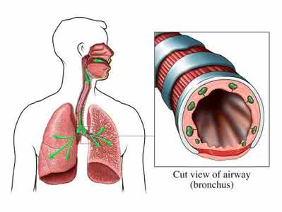 支气管炎的治疗方法 支气管炎的治疗 这些方法能治支气管炎
