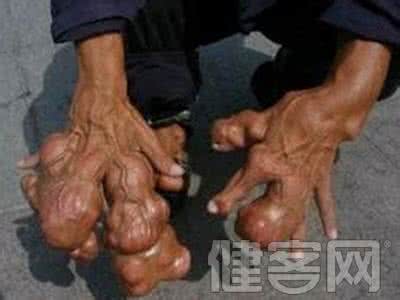 儿童手脚脱皮 儿童手脚脱皮 儿童手脚脱皮发病原因