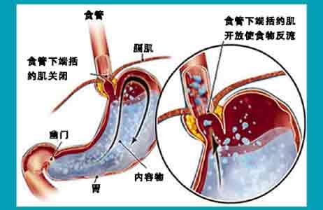 反流性食管炎症状治疗 反流食管炎 反流食管炎的症状与治疗