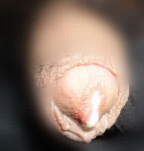 女性淋病的症状 淋病的症状