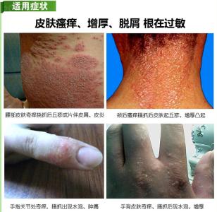 痱子和荨麻疹的区别 图文：皮肤湿疹、荨麻疹、痱子秘方二则