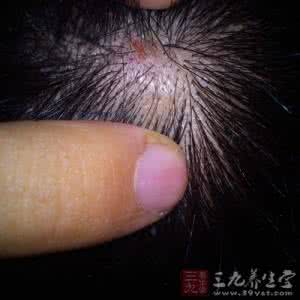 中医治疗头皮屑 头皮痒怎么办 中医治疗头皮痒有疗效