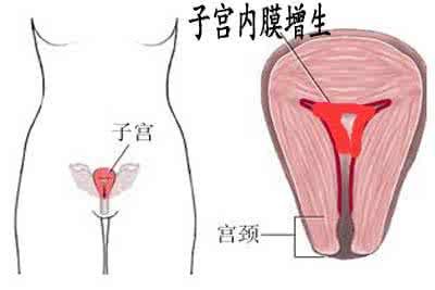 子宫内膜增厚的危害 子宫内膜增厚 女性内膜增厚有什么危害