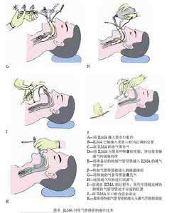 气管插管时间不宜超过 气管插管时间不宜超过 电热水器使用时间不宜超过6年