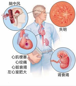 高血脂 血栓 高血脂，高血压，高血栓有福音了