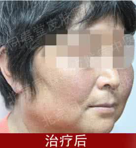 皮肤黑变病 皮肤黑变病 这些就是皮肤黑变病的病因