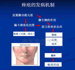 痤疮并发症 痤疮并发症 痤疮会带来哪些并发症