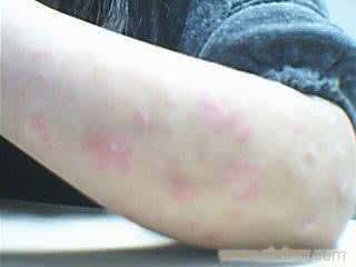 银屑病的饮食注意事项 银屑病注意事项 女性治疗银屑病的注意事项