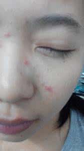 脸上白头粉刺怎么去除 白头粉刺怎么去除 激素脸长红疹子白头粉刺怎么办?