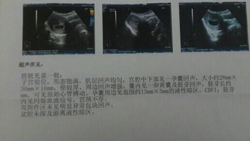 孕囊大小与孕周关系 空孕囊大小与孕周关系 孕囊大小与孕周的关系