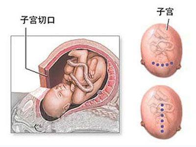 剖腹产后肚皮松弛下坠 剖腹产阴道会松弛吗 剖腹产不能避免阴道松弛！