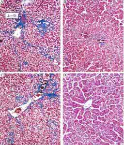 肝纤维化可以逆转吗 肝纤维化可以逆转吗 丙肝纤维化能逆转吗？