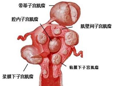 治疗子宫肌瘤得多少钱 为什么会得子宫肌瘤 子宫肌瘤如何治疗