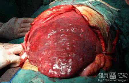 肝血管瘤严重吗 肝血管瘤严重吗 肝血管瘤肚子转吗？