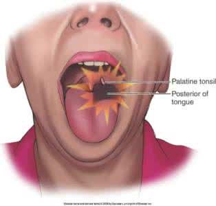 咽喉疼痛的原因 咽喉疼痛 这些原因导致咽喉疼痛