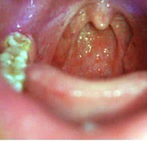 咽炎患者注意事项 13年的咽炎老患者，不用遭罪了，竟是被不起眼的古方治好了