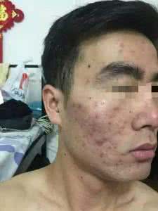 治疗痤疮最有效的药 痤疮怎么治疗