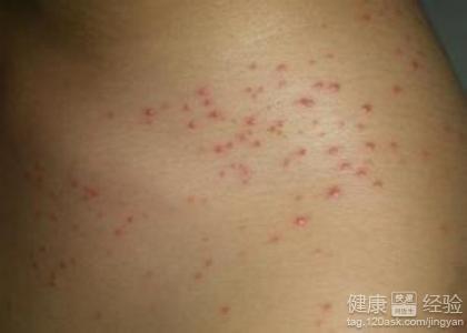 小孩风疹症状 小孩得了风疹又麻烦又难治 > 民间偏方