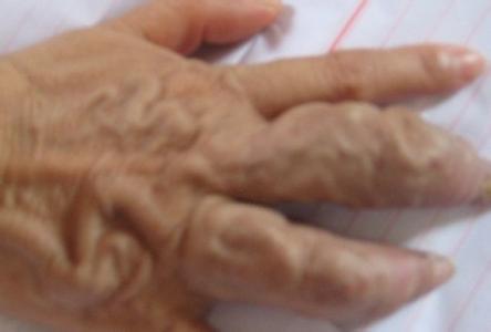 肝血管瘤 按摩 肝血管瘤通过按摩可消除