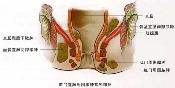 缓解肛门疼痛小妙招 缓解肛门疼痛小妙招 便后肛门疼痛 怎样缓解便后引起的疼痛