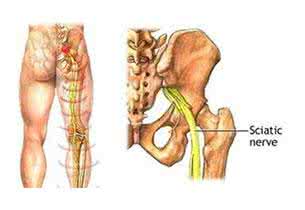 坐骨神经痛吃什么药 坐骨神经痛的治疗方法