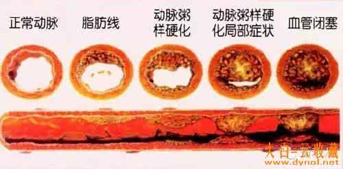 清理血管垃圾的食物 清理血管垃圾的食物 人过40血管堵，4种便宜食物可将血管垃圾清理得一干二净