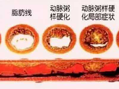 大脑血管堵塞怎么办 大脑血管堵塞怎么办 连通大脑的这根血管不能堵！清血管食物要多吃