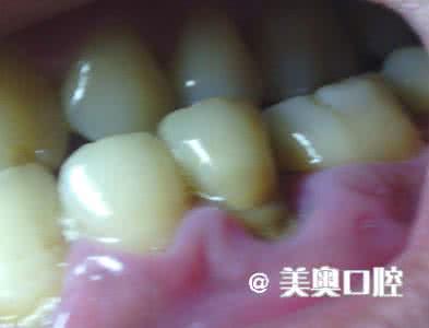 牙龈萎缩能长出来吗 牙龈萎缩