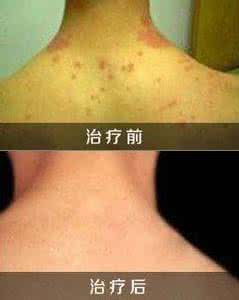 角化型湿疹的症状 角化型湿疹的症状 边角型白癜风的症状有哪些？
