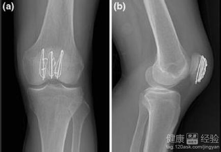 髌骨骨折治疗方法 髌骨骨折 髌骨骨折的治疗方法有哪些