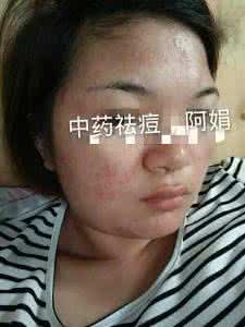 什么水果面膜能去痘 什么水果做面膜去痘呢