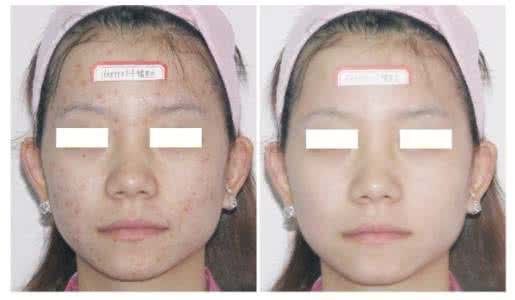 光子嫩肤祛痘效果 光子嫩肤祛痘 解答光子嫩肤祛痘有效果吗