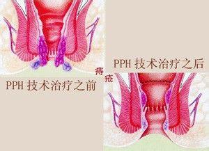 治疗痔疮的偏方 治疗痔疮