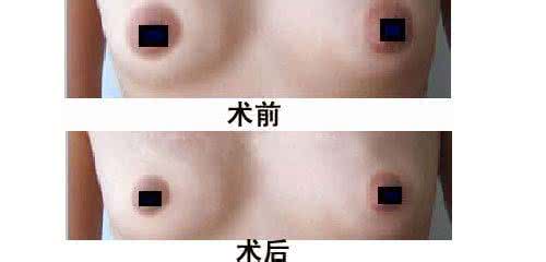 乳晕再造医院哪里好 乳晕颜色深代表什么 乳晕再造会出现什么并发症
