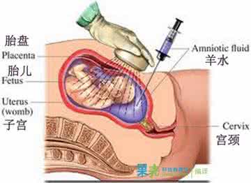 羊水穿刺什么情况下做 为什么要做羊水穿刺