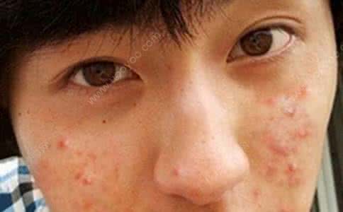 痘痘就是青春痘吗 有青春痘怎么办 脸上长痘怎么办,脸上有痘痘怎么办