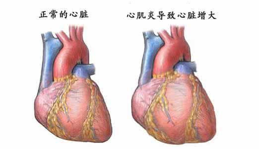 心肌炎有什么症状 心肌炎症状大盘点：成两极变化