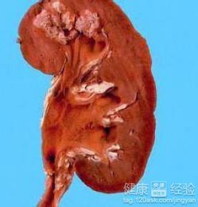 怎样治疗肾结核 肾结核症状 肾结核如何治疗
