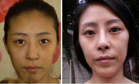 脂肪填充额头手术费用 脂肪填充额头手术费用 额头填充手术详解