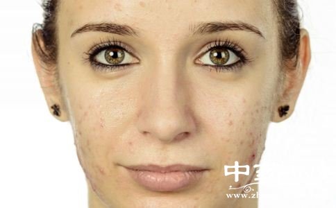 中医院皮肤科痘痘 中医治愈痘痘恢复健康皮肤如何做