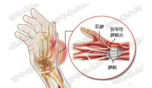 腱鞘炎是什么症状 腱鞘炎的症状 腱鞘炎是怎么引起的